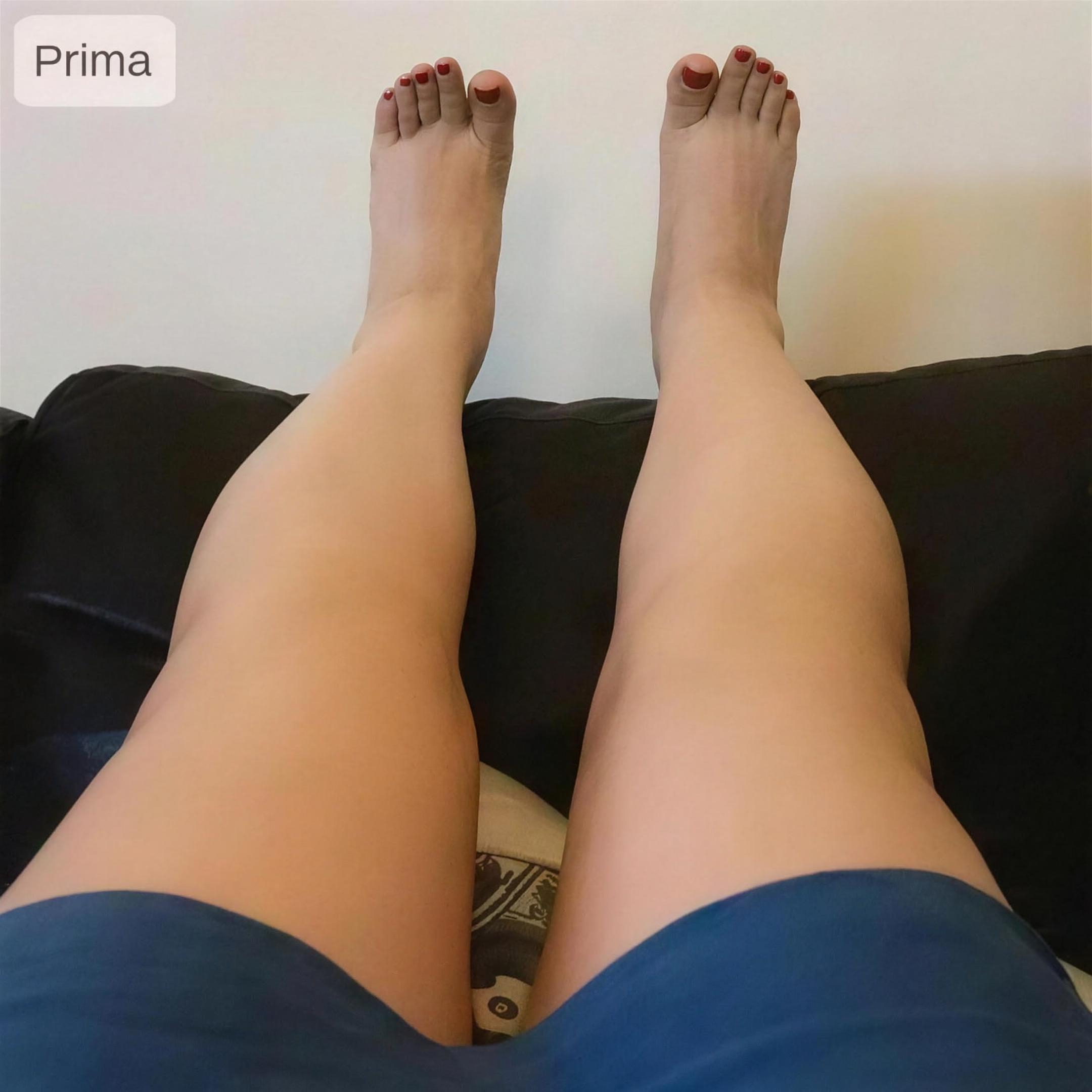 Prima (Giorno 1) — gambe prima del trattamento
